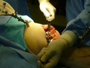 ナビゲーション人工膝関節置換術手術中写真