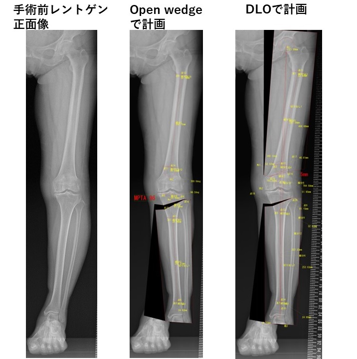 Double level osteotomy（DLO） | ​膝周囲骨切り術(高位脛骨骨切り術 